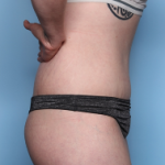 Body Lift Before & After Patient #34335